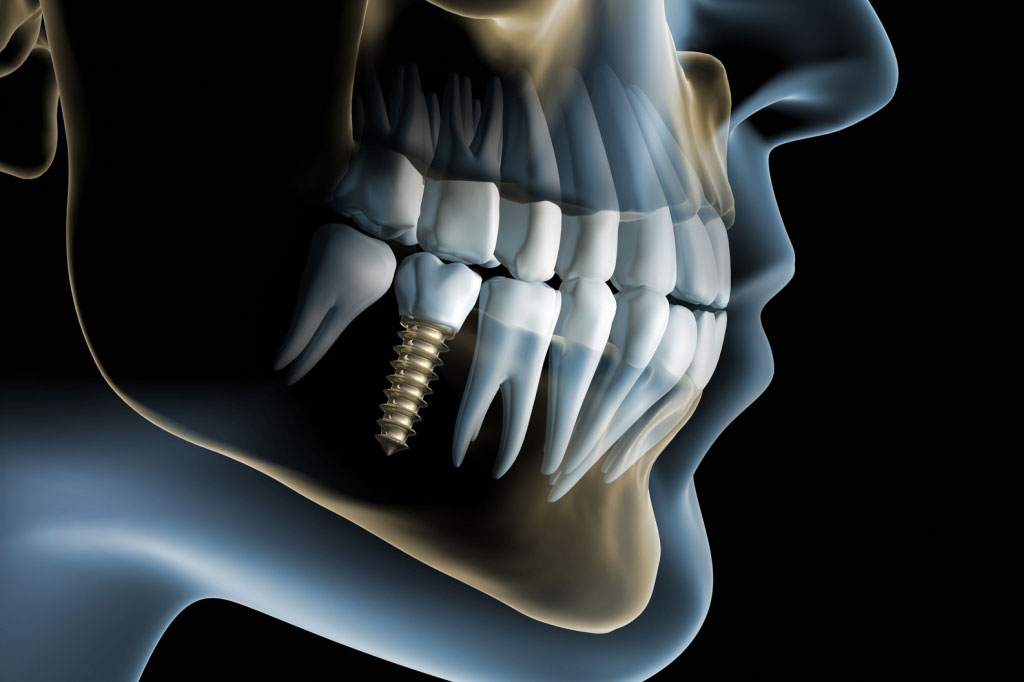 Dentalni implantati